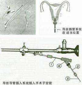 美國COOK輸卵管導絲介入術