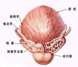 前列腺鈣化灶