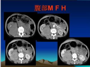 惡性纖維組織細胞瘤影像學