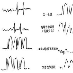 腦電圖