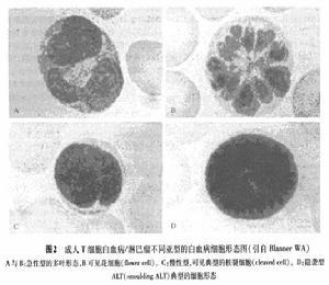 人類T淋巴細胞病毒感染