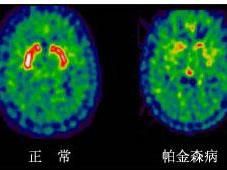 帕金森疊加綜合徵