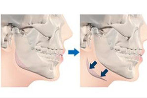 下頜角整形手術