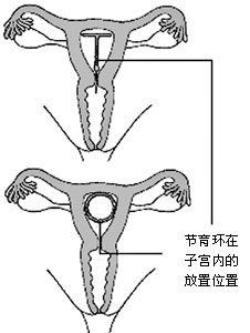 上環[避孕]