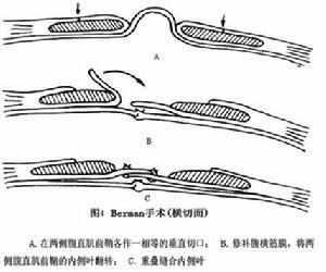 白線疝 圖4