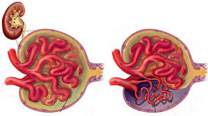 急性腎損傷