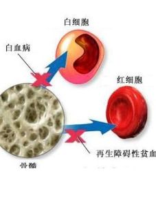 骨髓抑制