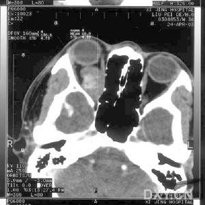 眼眶轉移性腫瘤