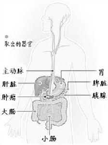 （圖）小腸平滑肌肉瘤