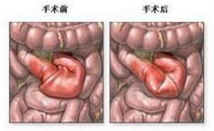 絞窄性腸梗阻