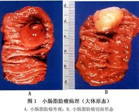 （圖）小腸脂肪瘤