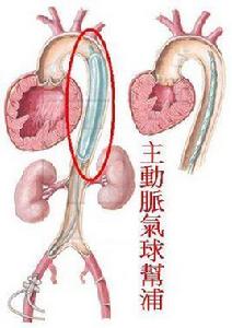主動脈內氣囊反搏術