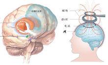 奧博百憂度抑鬱症治療儀