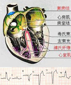 完全性左束支傳導阻滯