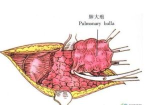 肺大皰切除術