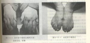 糖尿病性腎病變