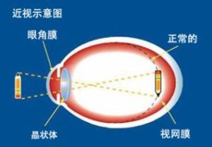 軸性近視