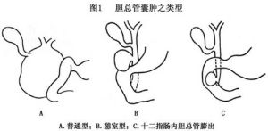 膽總管囊腫