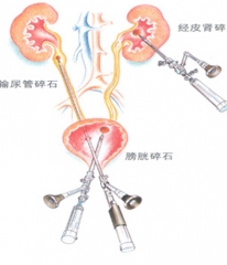 腎積水的手術治療