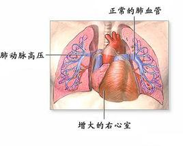 肺動脈段突出