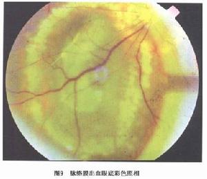 脈絡膜出血眼底彩色照相