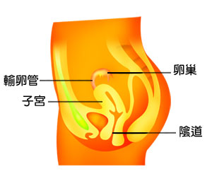 輸卵管膨出