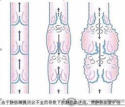 下肢交通靜脈瓣膜關閉不全