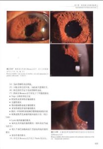 葡萄膜炎診斷與治療