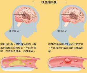 缺血性中風