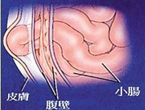 腹股溝疝氣