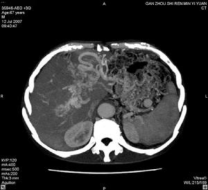 門脈高壓性腸病