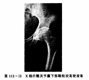 單發性骨軟骨瘤