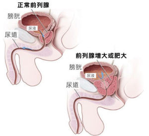 慢性前列腺炎