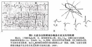 左前分支傳導阻滯