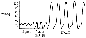 肺動脈狹窄