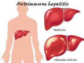 自身免疫性肝病
