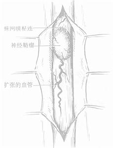 硬脊膜外膿腫