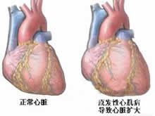 心尖肥厚型心肌病