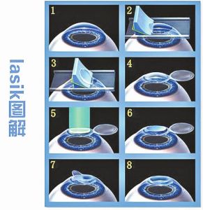 lasik近視治療技術