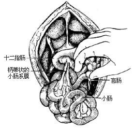 先天性腸旋轉不良