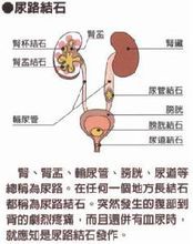 尿路結石