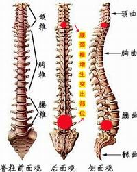 高位腰椎間盤突出症