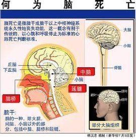 腦死亡