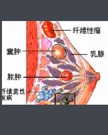 乳房囊腫