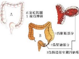 膈上食管憩室