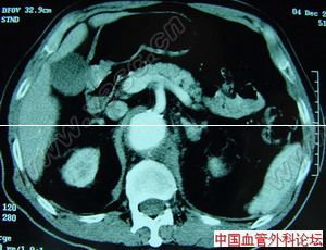 主動脈竇動脈瘤破裂