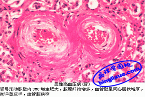 急性腎上腺皮質功能衰竭