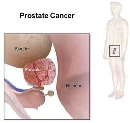 老年人前列腺癌