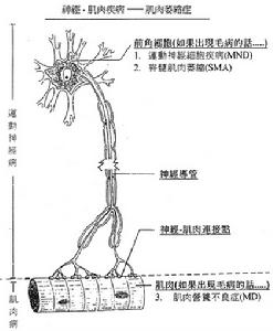 脊髓性肌肉萎縮症