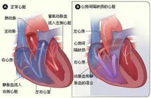 心內膜墊缺損